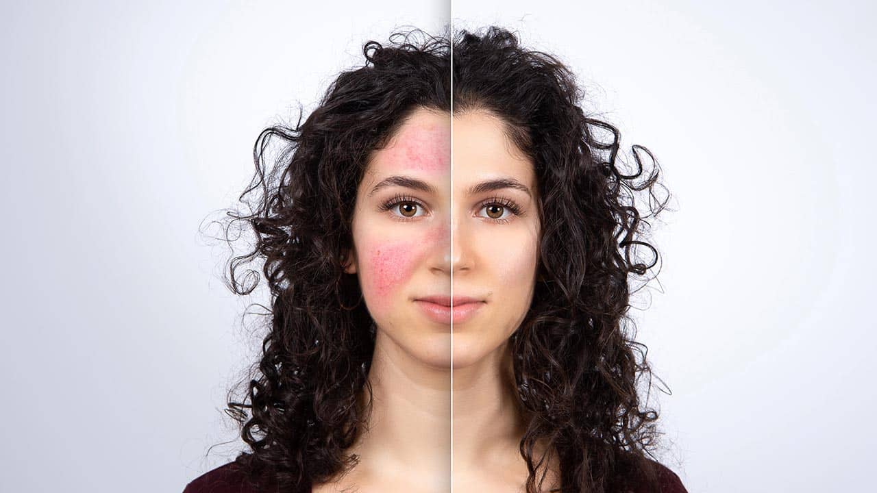 טיפול לאקנה רוזציאה