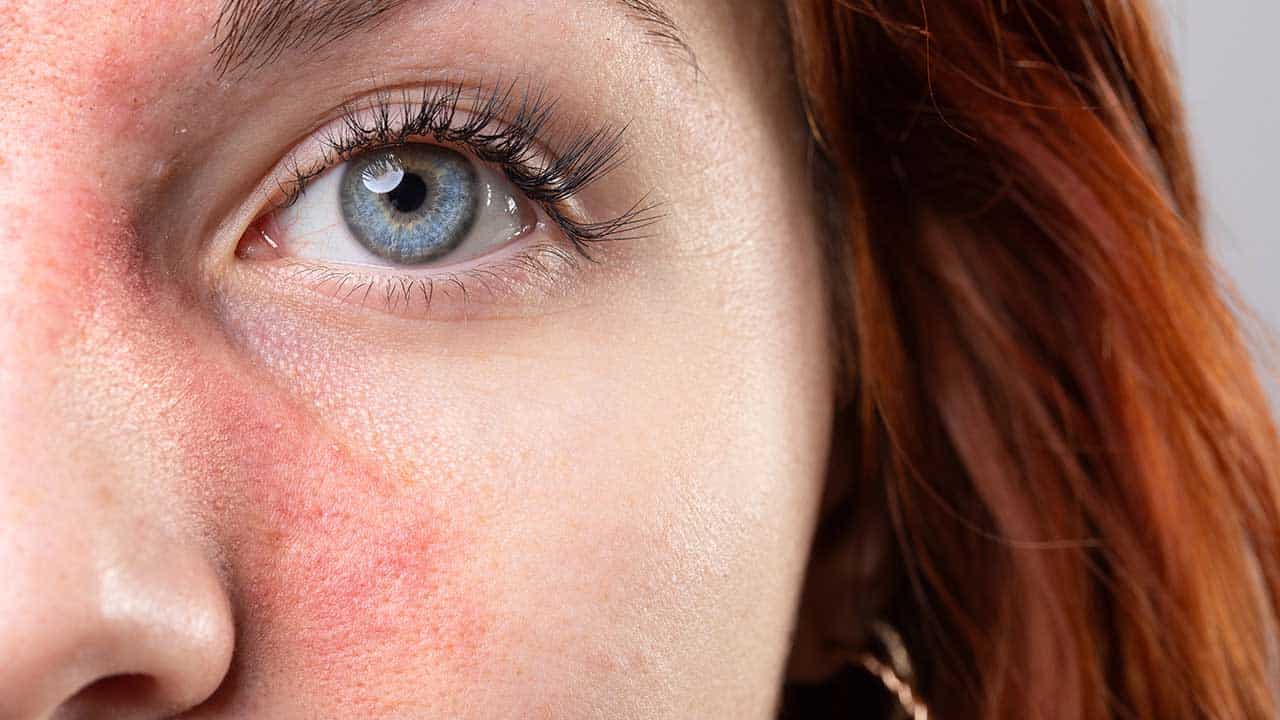 אקנה רוזציאה