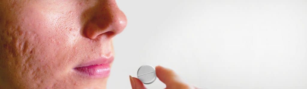 רואקוטן על צלקות אקנה