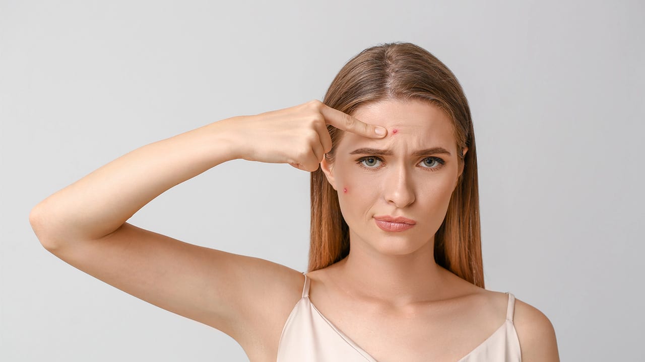 הסרת צלקות אקנה בשיטת רבקה זיידה