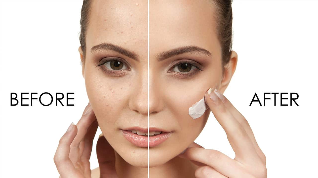 משחה לחצ'קונים שבאמת עובדת